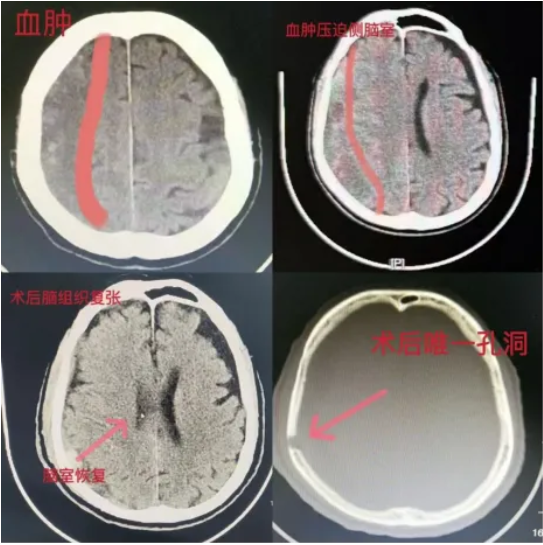 【健康科普】警惕老年人的沉默殺手，認識慢性硬膜下血腫