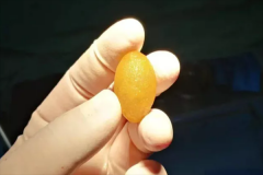 余生，“肝膽相照”——新式內鏡微創保膽手術